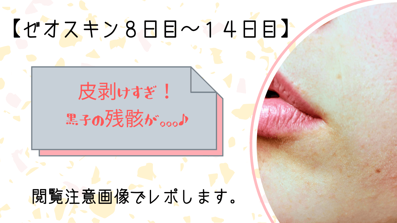 ゼオスキン二週間目 40代50代必見 ほくろの残骸が無くなる
